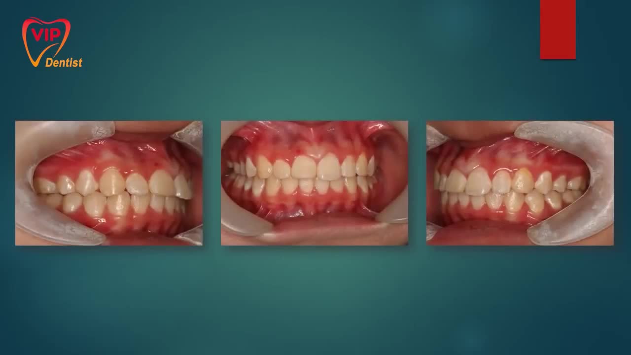 HÀNH TRÌNH NIỀNG RĂNG CỦA KHÁCH HÀNG VIP DENTIST