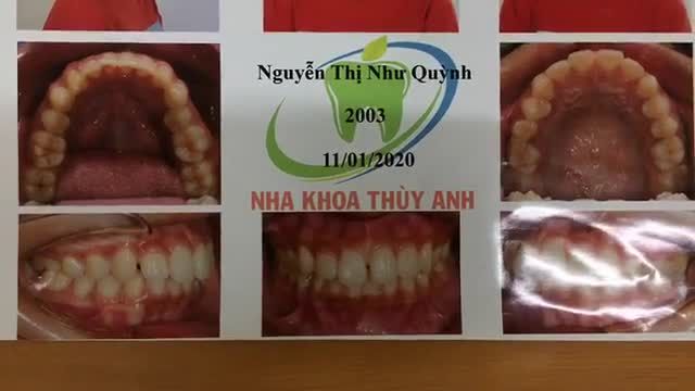 Gắn mắc cài cho bạn Như Quỳnh tại Nha Khoa Thuỳ Anh.