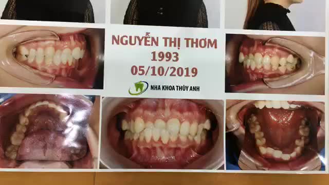 Gắn mắc cài cho chị Thơm tại Nha Khoa Thuỳ Anh.