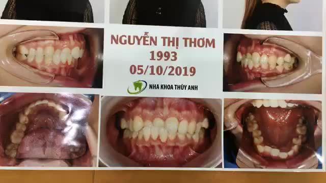 Gắn mắc cài cho chị Thơm tại Nha Khoa Thuỳ Anh.