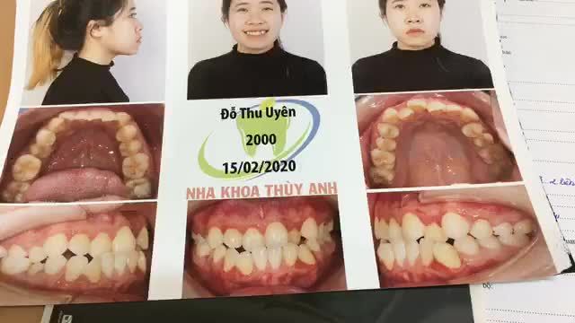 Gắn mắc cài cho bạn Uyên tại Nha Khoa Thuỳ Anh.