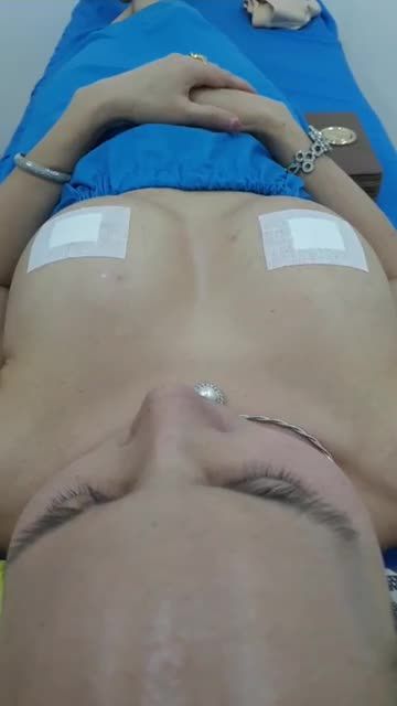 NÂNG NGỰC NỘI SOI CHÂN KHÔNG NẠO FILLER THU NHỎ ĐẦU TI 360CC BÊN TRÁI , 360 CC BÊN PHẢI