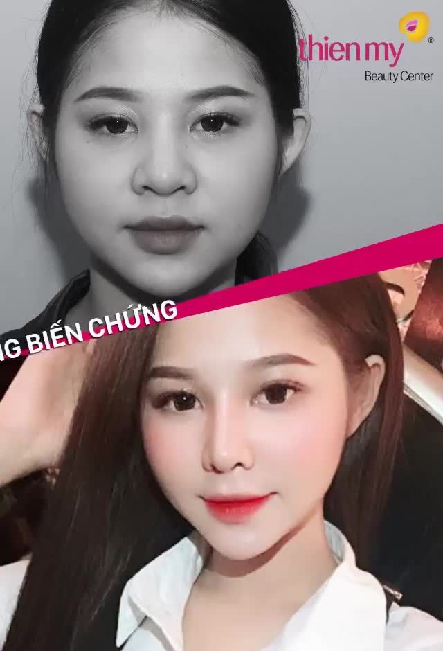 Nâng mũi bọc sụn 4s 2 lớp - SỞ HỮU DÁNG MŨI TỰ NHIÊN "CHUẨN" NHƯ MONG ĐỢI.