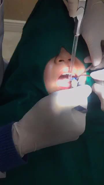 Nhổ răng 38 siêu cong, siêu lệch ngầm 90 độ bằng máy siêu âm.