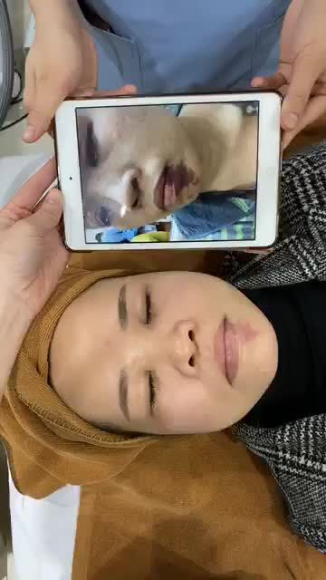 VBEAM - Công nghệ laser hiện đại tại Dr Hoàng Tuấn