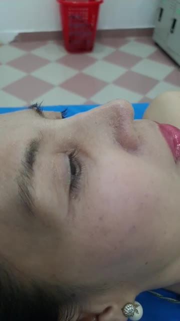Nâng mũi cấu trúc đa lớp Dáng Sline kết hợp Lline Đầu mũi tròn phong thủy Quá đẹp sau 10 ngày