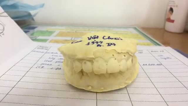 Gắn mắc cài cho bạn Chiến tại Nha Khoa Thùy Anh.
