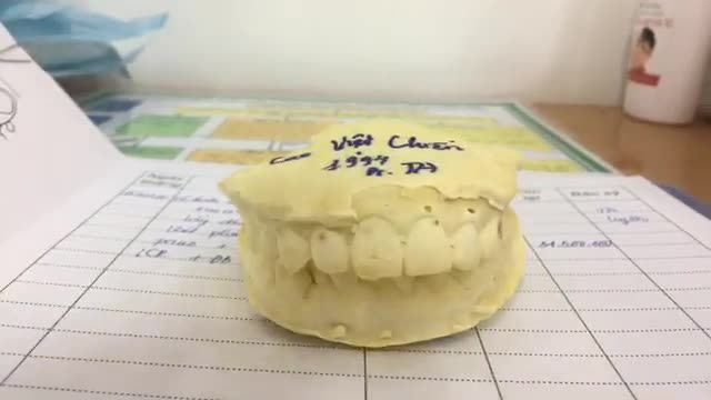 Gắn mắc cài cho bạn Chiến tại Nha Khoa Thùy Anh.