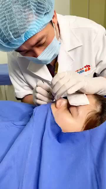 SAU 10 NGÀY Mũi S-line lên dáng cực MÊ