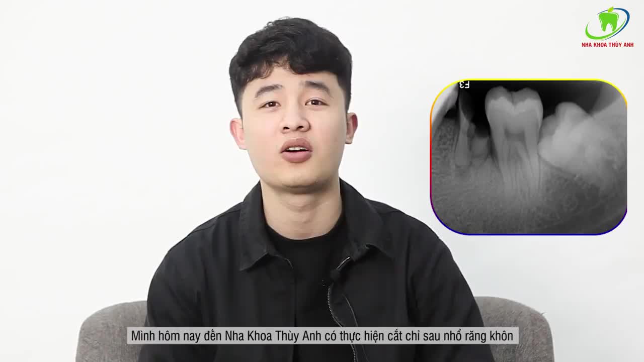 BẤT NGỜ NHỔ RĂNG KHÔN LỆCH 90 ĐỘ KHÔNG ĐAU TẠI NHA KHOA THUỲ ANH