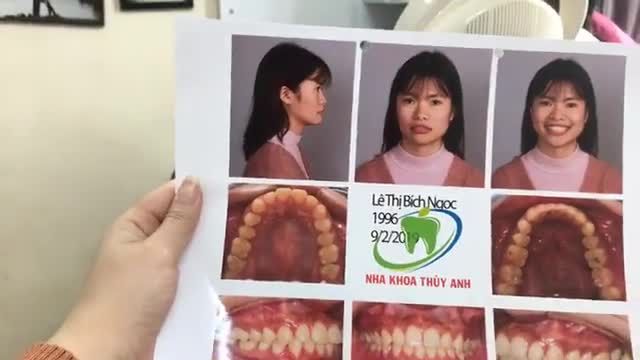 Gắn mắc cài hàm dưới cho bạn Bích Ngọc. Mắc cài sứ tự buộc, thẩm mỹ ưu việt nhất hiện nay.