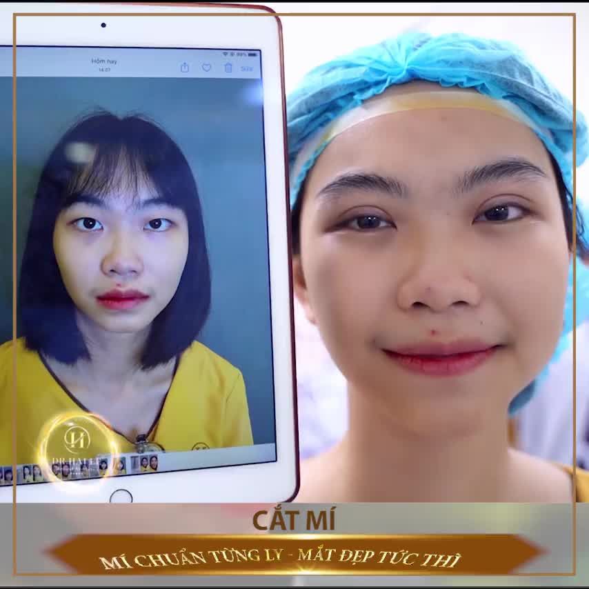 MÃN NHÃN VỚI KẾT QUẢ CẮT MÍ MANI MINI DEEP 5D TẠI DR. HẢI LÊ !
