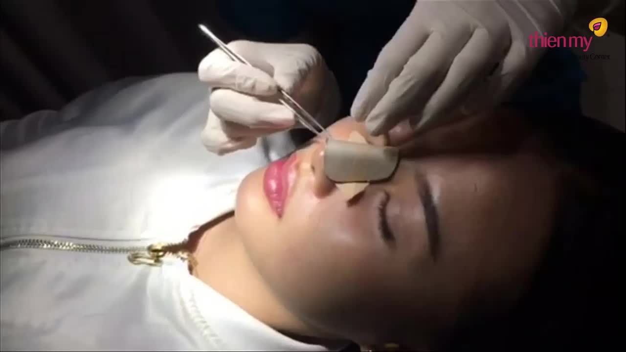 Khách hàng gỡ nẹp sau 7 NGÀY NÂNG MŨI bọc sụn 4s 2lớp.