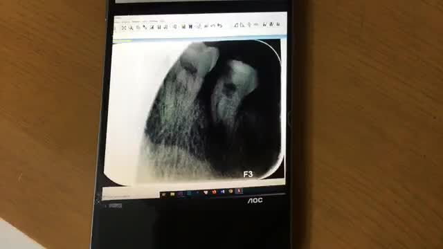 Nhổ răng khôn sâu viêm tuỷ gây đau nhức cho anh Tuấn