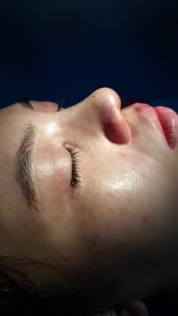 Nâng mũi cấu trúc đa lớp Dáng Sline mềm mại Đầu mũi cao bay Quá đẹp cho em gái Quận 7