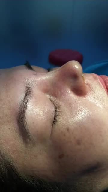 Nâng mũi bán cấu trúc Dáng Sline mềm mại Thu nhỏ đầu mũi