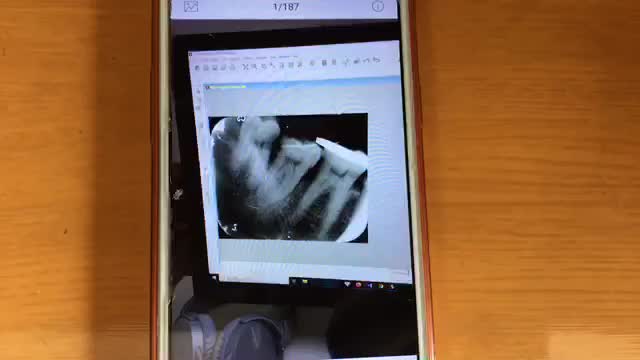 Nhổ răng khôn mọc trồi, sâu, nhồi nhét thức ăn gây đau cho bác Kính.
