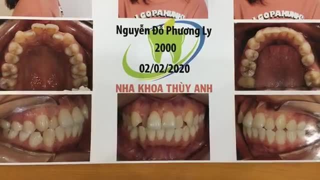Gắn mắc cài tại Nha Khoa Thuỳ Anh.