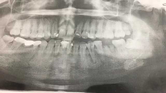 Cấy chân răng nhân tạo implant tại Nha Khoa Thuỳ Anh.