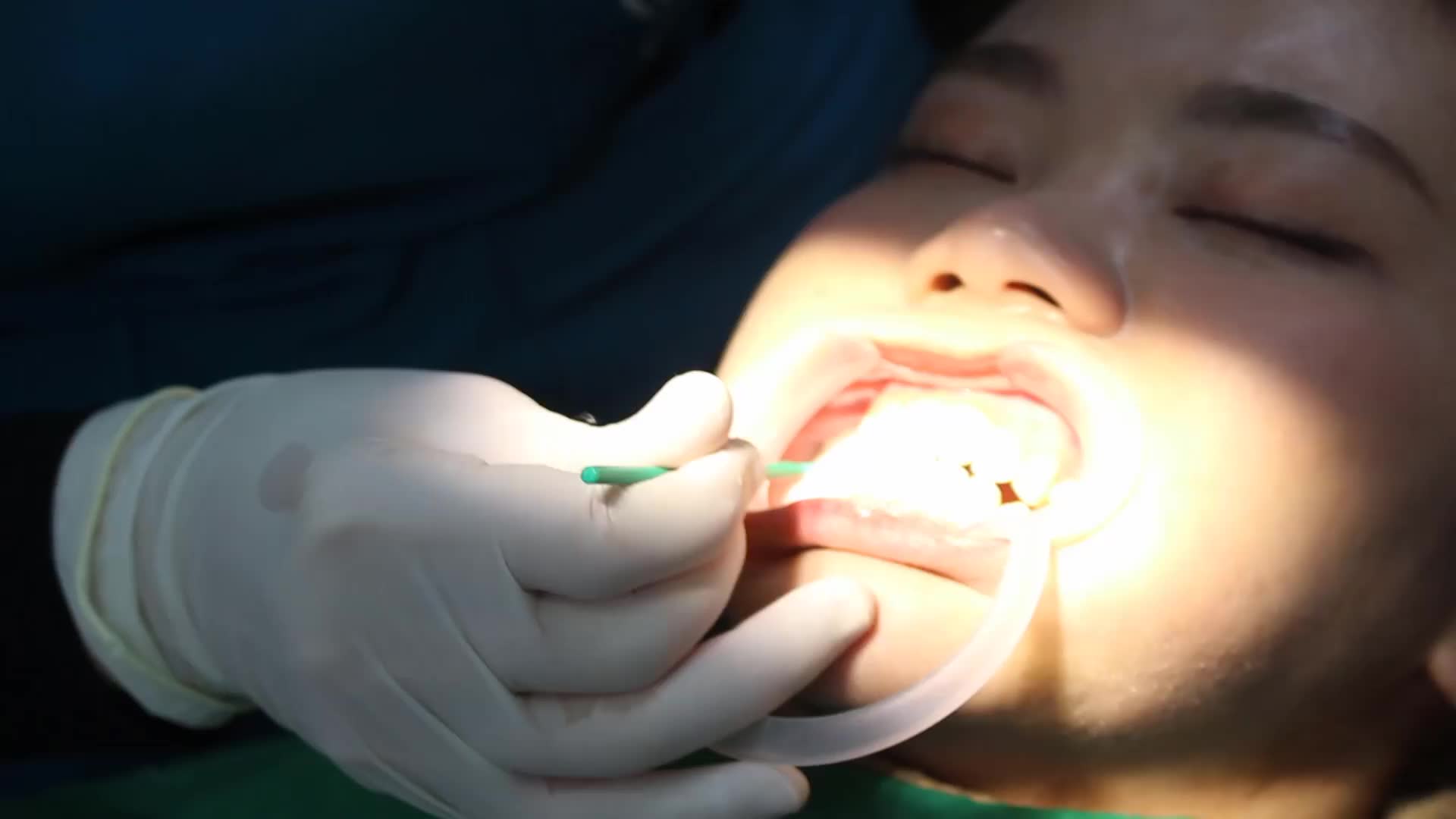 Case gắn mắc cài pha lê cho bệnh nhân T. K. H - 19 tuổi ở Hà Nội