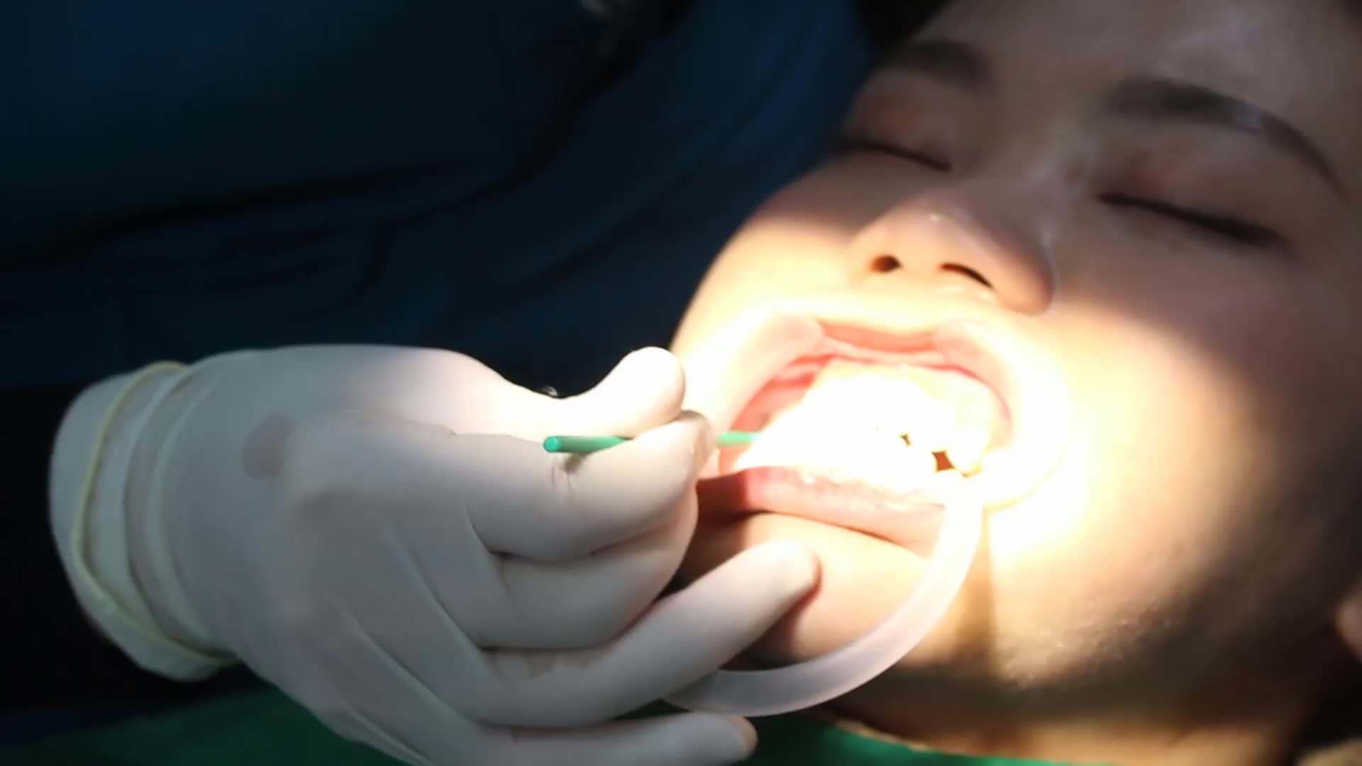 Case gắn mắc cài pha lê cho bệnh nhân T. K. H - 19 tuổi ở Hà Nội
