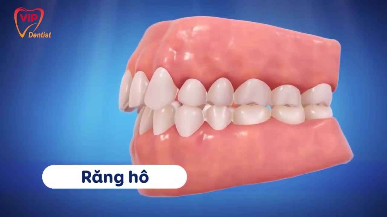 Niềng răng không cần nhổ răng Niềng răng mà không ai phát hiện Tìm kiếm bác sĩ có chuyên môn, có tâm