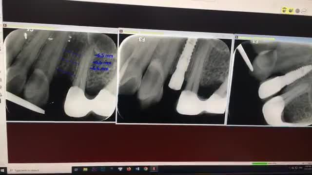 Lắp răng implant R24 cho anh Hanh tại Nha Khoa Thuỳ Anh.