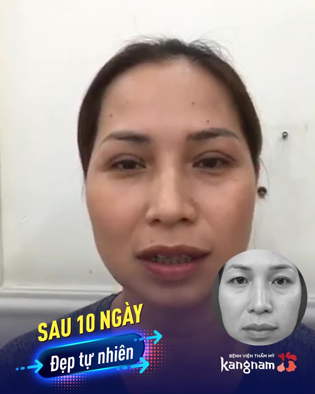 Sau Cắt Mí - Mắt SẼ HỒI PHỤC THẾ NÀO?