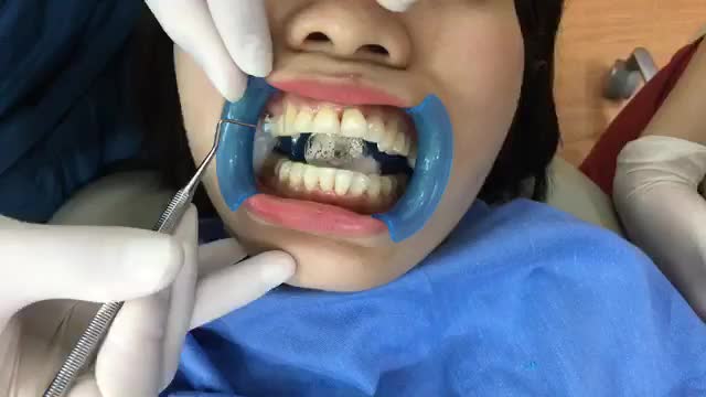Gắn mắc cài sứ thông minh cho chị Tâm.