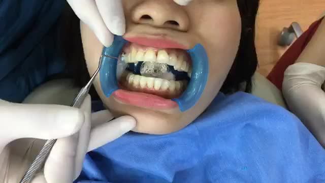 Gắn mắc cài sứ thông minh cho chị Tâm.