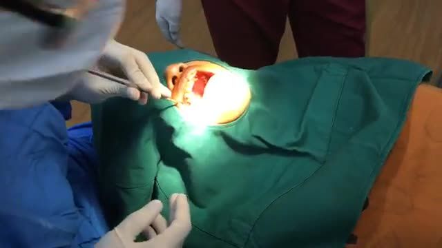 CẤY CHÂN RĂNG NHÂN TẠO TẠI NHA KHOA THÙY ANH