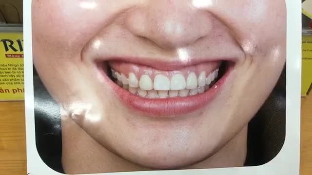Điều trị cười hở lợi bằng phương pháp làm dài thân răng cho chị Thơm.