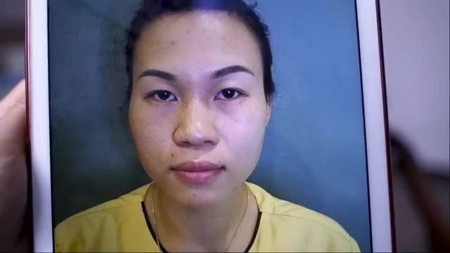 NGẮM NHÌN KẾT QUẢ SAU 7 NGÀY KHẮC PHỤC HOÀN TOÀN những KHUYẾT ĐIỂM của đôi mắt với Công nghệ Cắt mí đỉnh cao MANI MINI DEEP 5D tại Dr. Hải Lê.