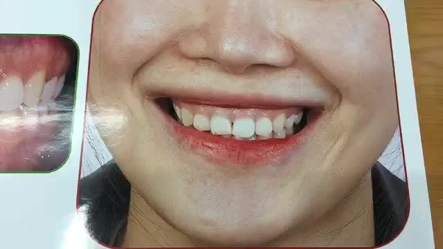 Điều trị cười hở lợi cho bạn Phương Thảo