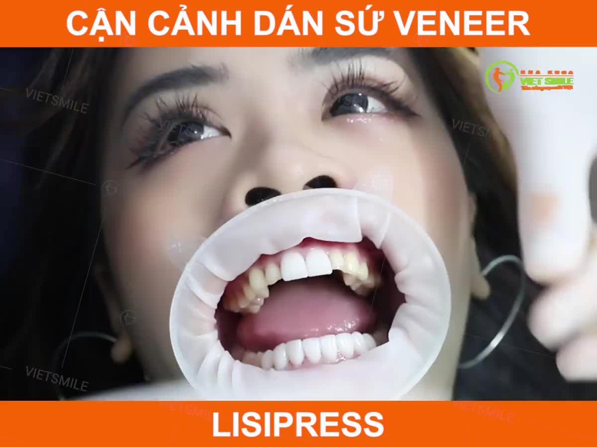 CẬN CẢNH DÁN SỨ VENEER LISI PRESS TẠI NHA KHOA VIET SMILE