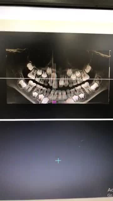 Case Nhổ răng khôn