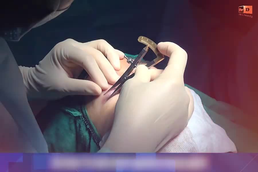 Cắt mí Elite Eyes - THẨM MỸ MẮT CÙNG CHUYÊN GIA