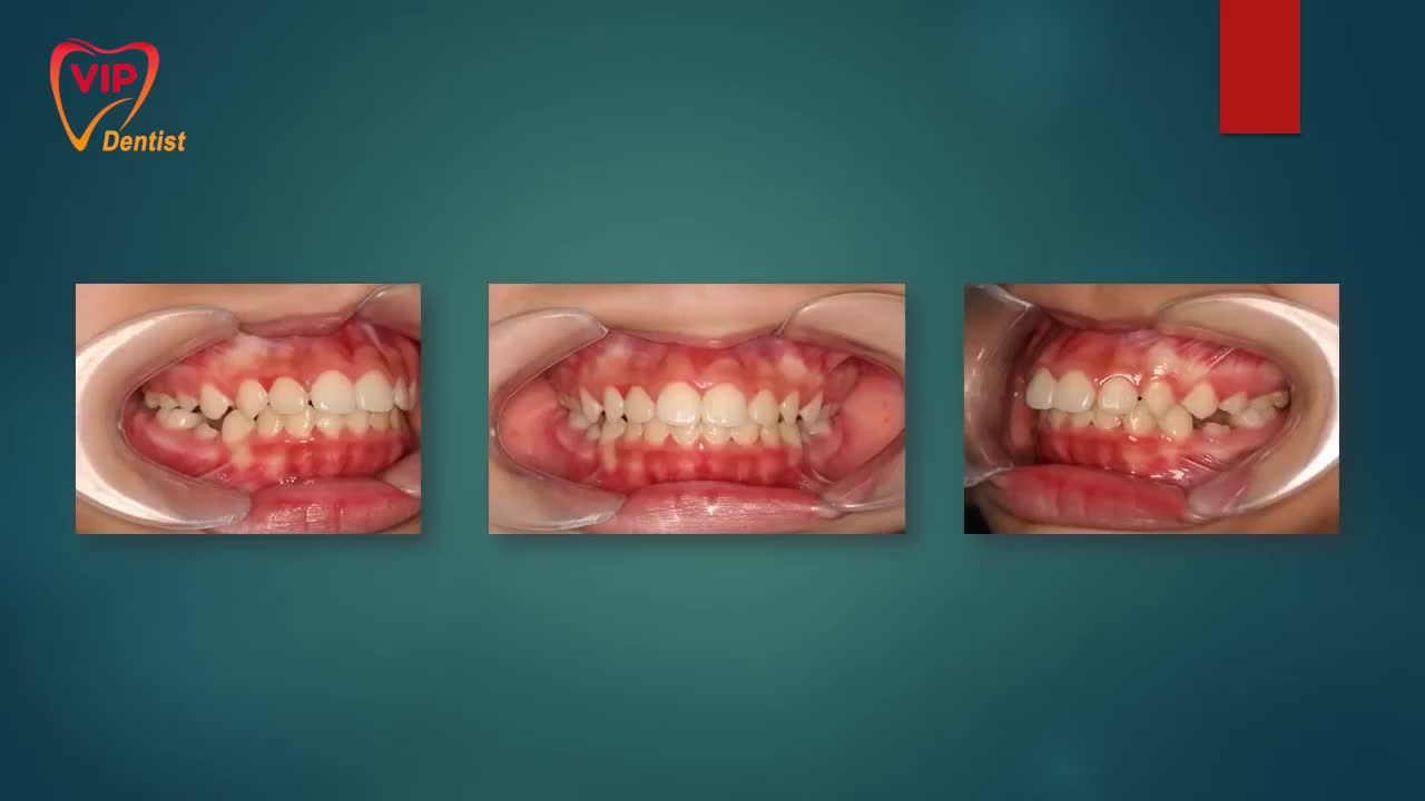 HÀNH TRÌNH NIỀNG RĂNG CỦA KHÁCH HÀNG VIP DENTIST