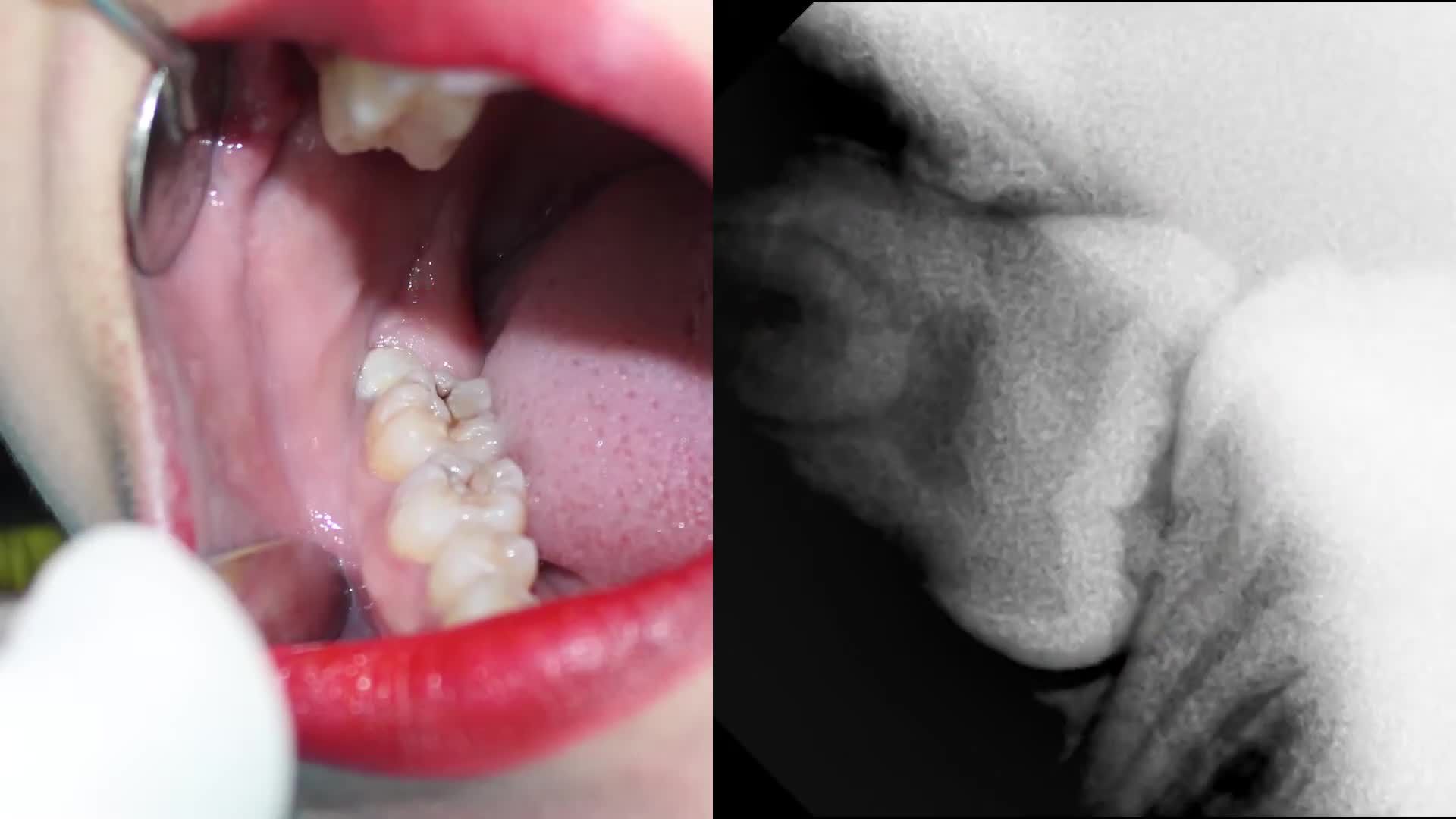 LẦN THỨ 2 BỆNH NHÂN QUAY LẠI NHỔ RĂNG KHÔN TẠI NHA KHOA ĐÔNG NAM