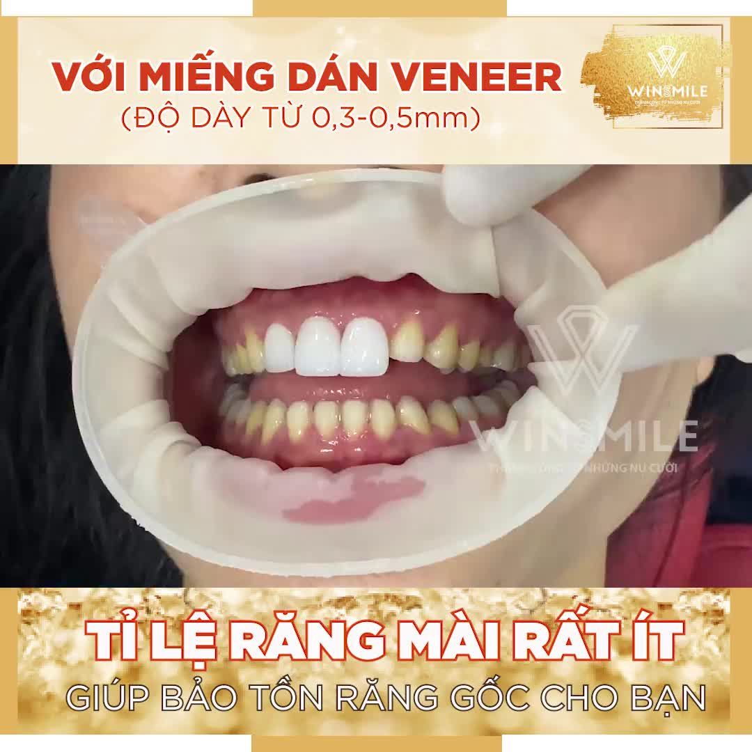 MẶT DÁN SỨ VENEER SIÊU MỎNG - BẢO TỒN RĂNG GỐC - GIỮ NGUYÊN RĂNG THẬT