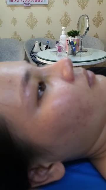 Nâng mũi bán cấu trúc 2 lớp