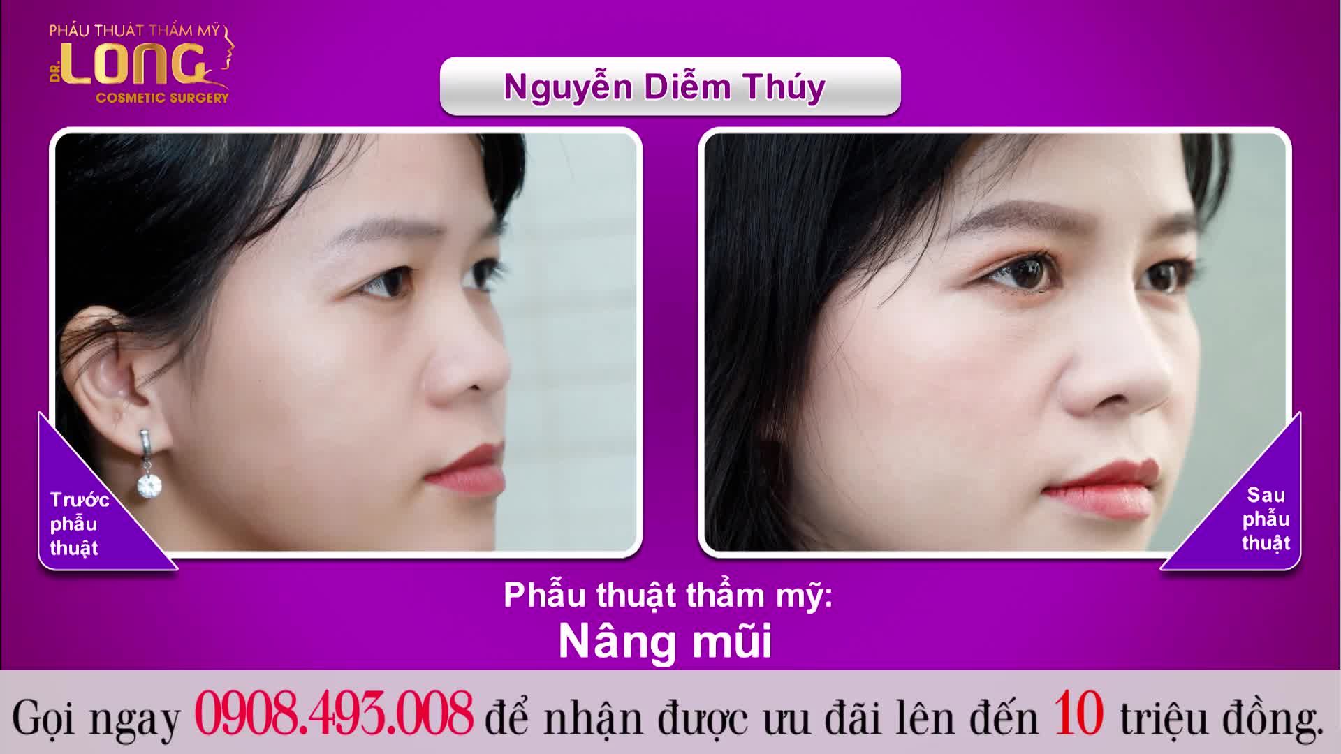 NÂNG MŨI XONG LÀ CẢ KHUÔN MẶT SẼ ĐẸP THEO - BẠN CÓ TIN KHÔNG
