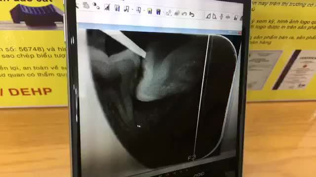 Nhổ răng khôn mọc lệch 90 độ cho anh Toàn.