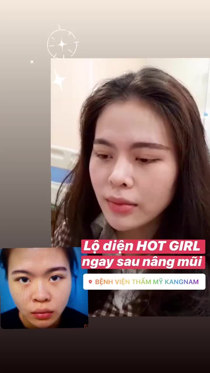 Nữ khách hàng này đã làm dịch vụ nâng mũi nào?
