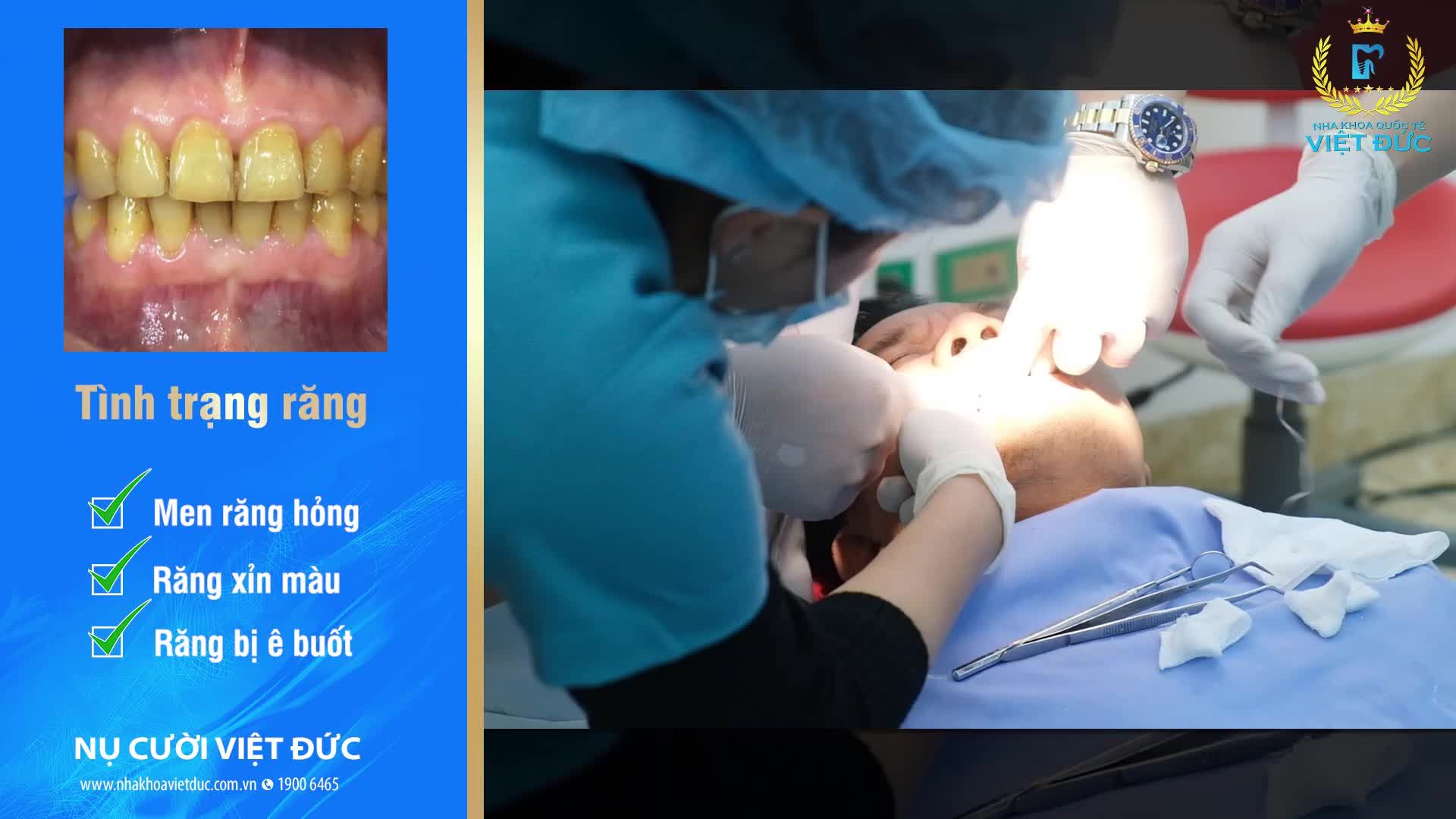 RĂNG ĐẸP MÀU SẮC, HÌNH THỂ CHUẨN NHÂN TƯỚNG CHỈ SAU 02 LẦN HẸN