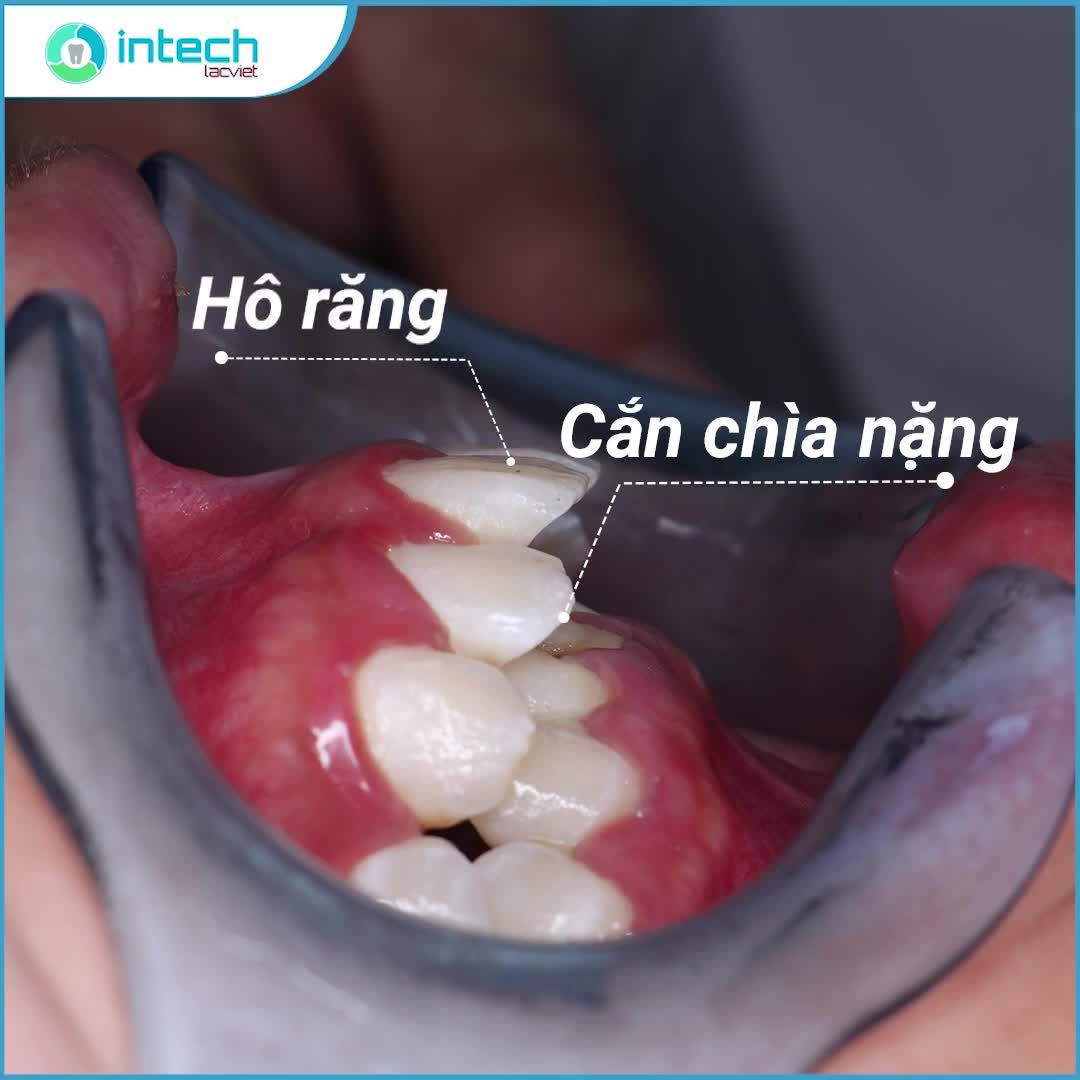 KHÁCH HÀNG CHIA SẺ CẢM NHẬN Trải nghiệm sau 12 tháng niềng răng mắc cài