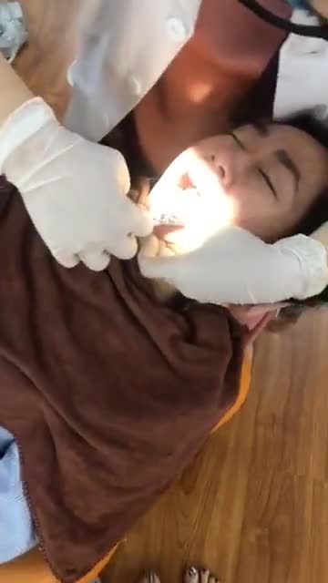 Quá trình tháo mắc cài như thế nào ? Thời gian niềng răng khấp khểnh là bao lâu ?