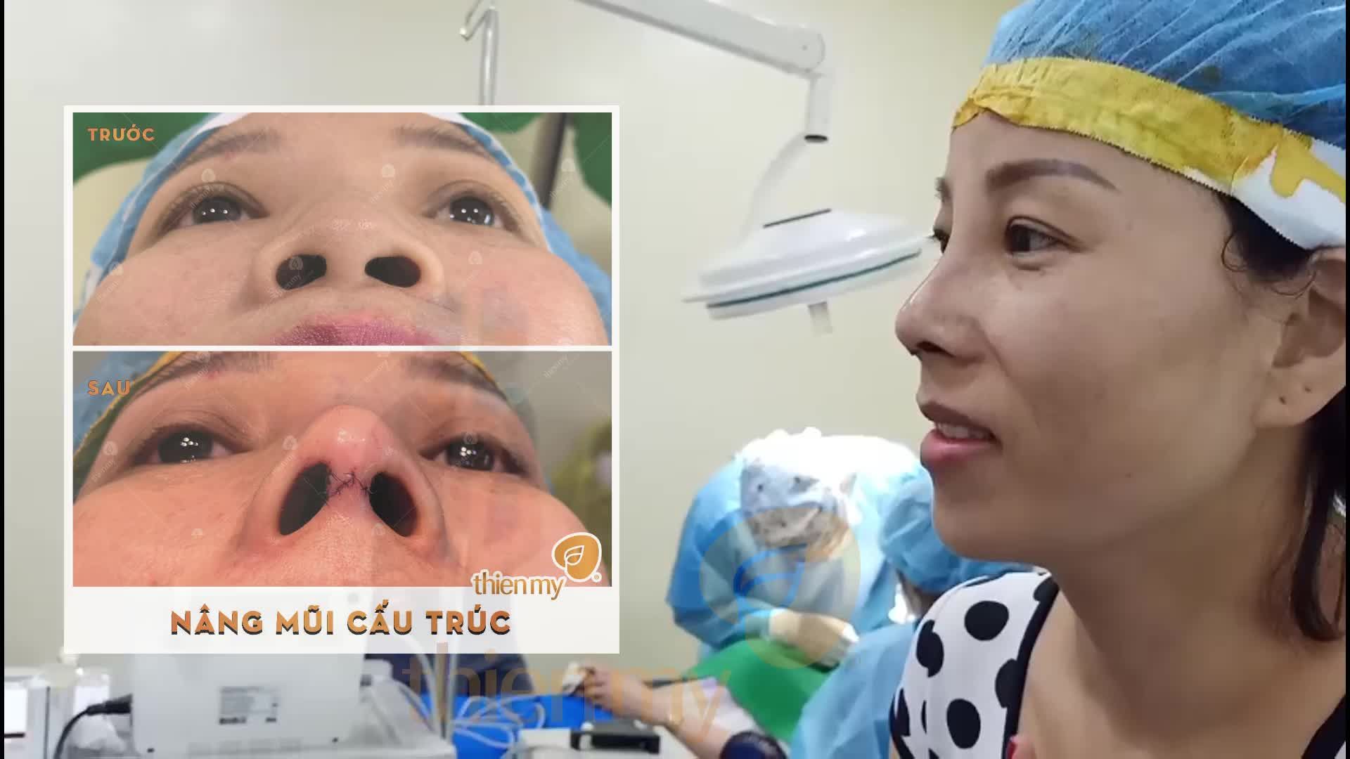 Vô cùng hài lòng với chiếc mũi được sửa lại bằng Phương pháp Nâng mũi Cấu trúc 4s Nanotex từ bàn tay của Bác sĩ Thường.