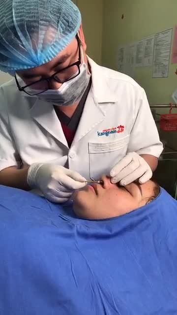Quá trình tái khám cắt chỉ sau nâng mũi cấu trúc 4D chỉ 10 ngày