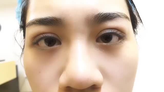 Kết quả mí Cắt Mí Mani Mini Deep 5D - Dr.Hải Lê đẹp ngoài sự mong đợi, đường cắt nhỏ, không sưng, không đau, duy trì dài lâu